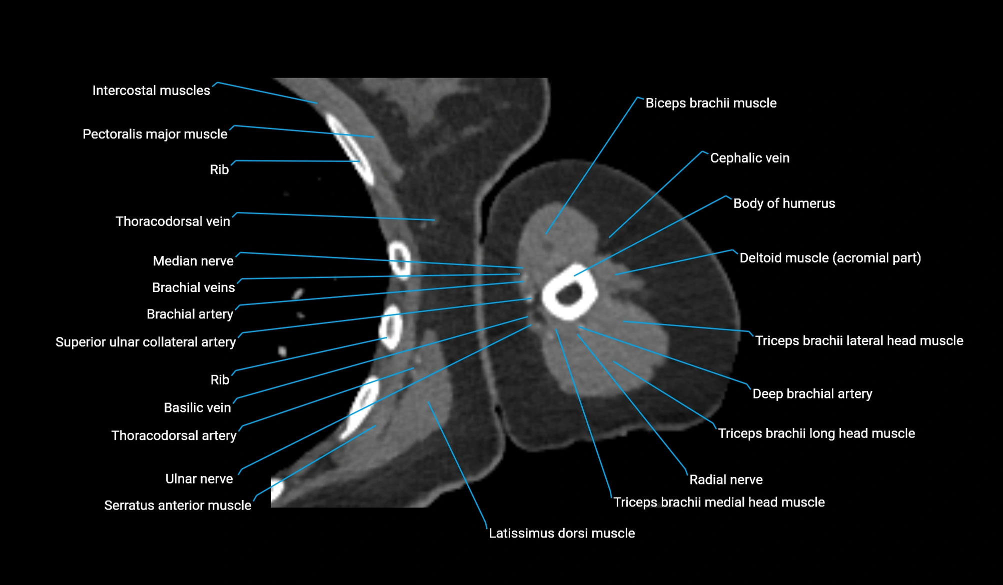 CT upper arm axial  cross sectional anatomy labelled radiology image -00212.webp
